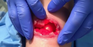 Cuando la piel cede: entendiendo la infección de la herida quirúrgica y la dehiscencia
