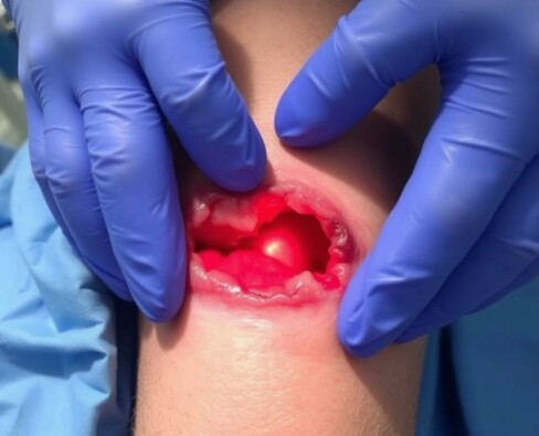 Cuando la piel cede: entendiendo la infección de la herida quirúrgica y la dehiscencia