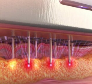 Синяк под ногтем на руке: что с этим делать?