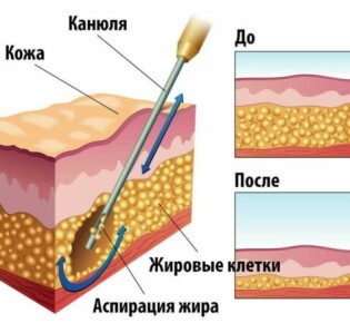 Холедохоэктазия при удалённом желчном пузыре: что это такое