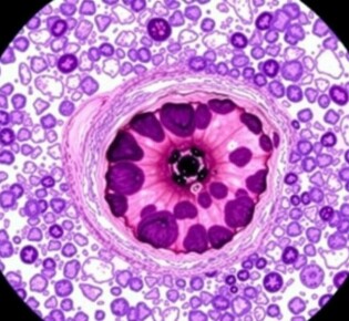 Die faszinierende Welt der histologischen Untersuchung des entfernten Wurmfortsatzes