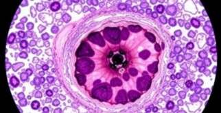 Die faszinierende Welt der histologischen Untersuchung des entfernten Wurmfortsatzes