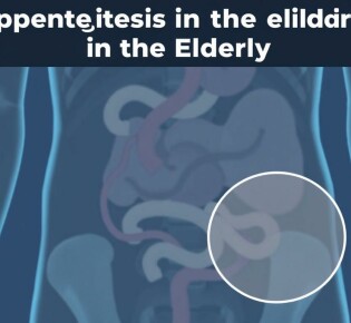 Understanding Appendicitis in the Elderly: Symptoms, Diagnosis, and Treatment