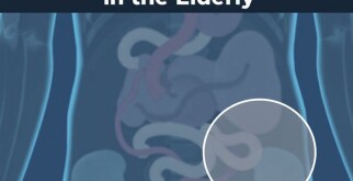 Understanding Appendicitis in the Elderly: Symptoms, Diagnosis, and Treatment