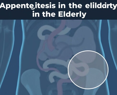 Understanding Appendicitis in the Elderly: Symptoms, Diagnosis, and Treatment