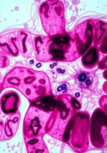 Descifrando el informe: La significación de los resultados anatomopatológicos del apéndice