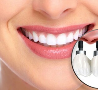 Имплантация зубов и другие услуги стоматологической клиники