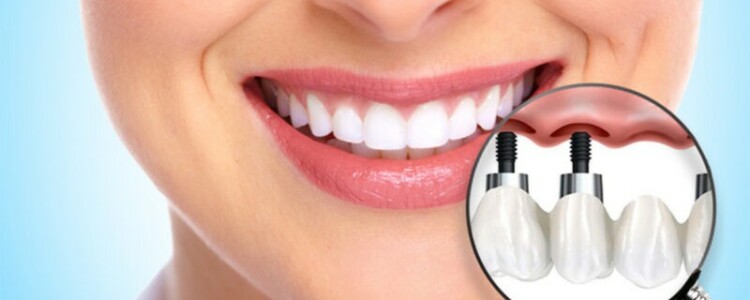 Имплантация зубов и другие услуги стоматологической клиники