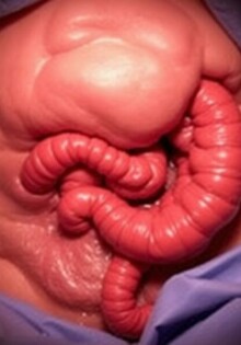 Apendicectomía intervalar: ¿por qué y cuándo programar la cirugía después del tratamiento con antibióticos?