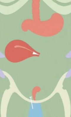 Appendicite Gangréneuse : Dangers et Traitements