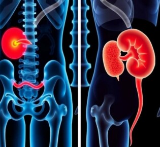 Appendizitis vs. Nierenkolik: cómo distinguir dos dolores abdominales que pueden asustar a cualquiera