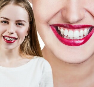 Функциональные преимущества брекетов