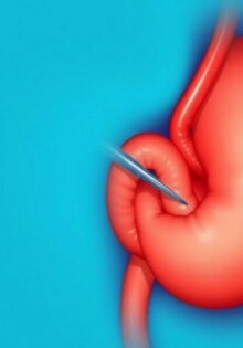 Die Appendizitis als Fallbeispiel in der mündlichen Prüfung: cómo convertir un caso común en una presentación memorable