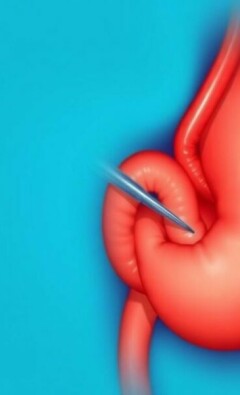 Die Appendizitis als Fallbeispiel in der mündlichen Prüfung: cómo convertir un caso común en una presentación memorable