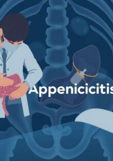 Apéndice en el punto de mira: Desmontando los mitos más comunes sobre la apendicitis
