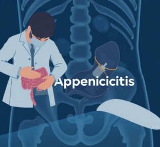 Apéndice en el punto de mira: Desmontando los mitos más comunes sobre la apendicitis