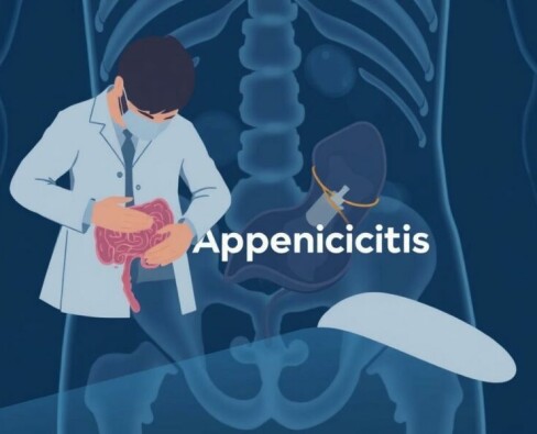 Apéndice en el punto de mira: Desmontando los mitos más comunes sobre la apendicitis
