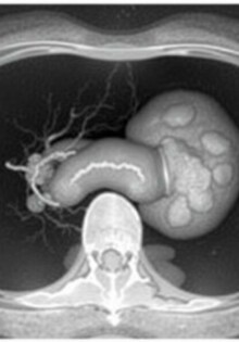 Understanding Rovsing’s Sign in Appendicitis: A Vital Diagnostic Clue