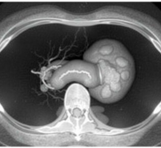 Understanding Rovsing’s Sign in Appendicitis: A Vital Diagnostic Clue