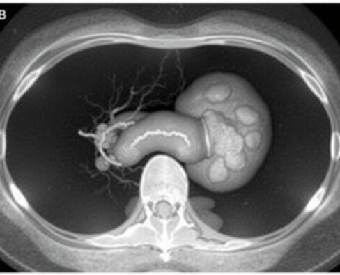 Understanding Rovsing’s Sign in Appendicitis: A Vital Diagnostic Clue