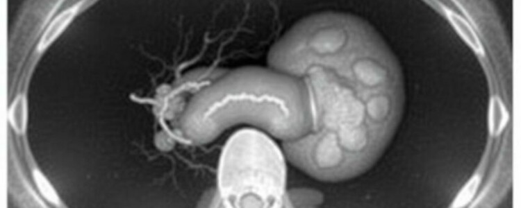 Understanding Rovsing’s Sign in Appendicitis: A Vital Diagnostic Clue