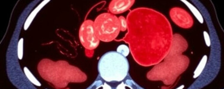 Appendicite et Scanner : Pourquoi est-il Souvent Nécessaire ?