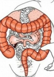 La mortalidad ligada a la apendicitis antes de la era de los antibióticos: cómo una pequeña víscera cambió vidas y medicina