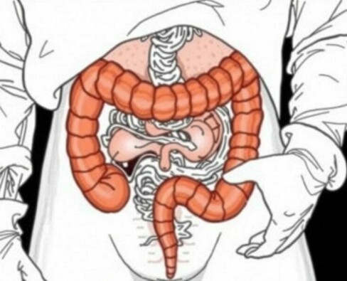 La mortalidad ligada a la apendicitis antes de la era de los antibióticos: cómo una pequeña víscera cambió vidas y medicina