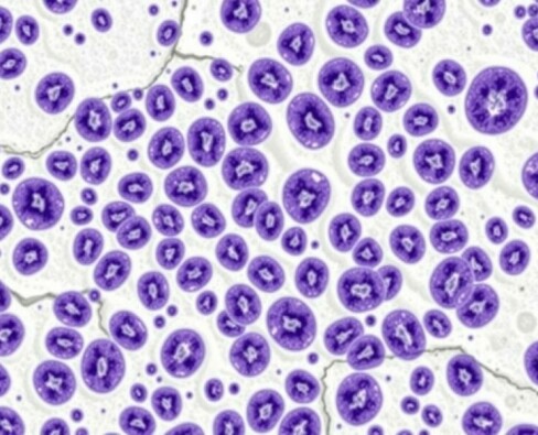 L’hyperplasie lymphoïde de la paroi: entender un fenómeno invisible pero significativo