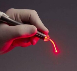 Лазерное удаление геморроя