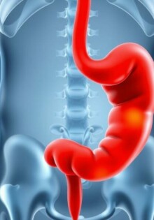 La modélisation du riesgo individual de desarrollar una apendicitis: cómo pensar, medir y predecir lo inesperado