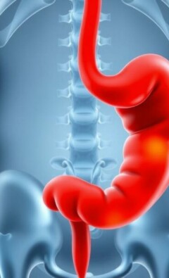 La modélisation du riesgo individual de desarrollar una apendicitis: cómo pensar, medir y predecir lo inesperado