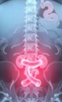 Understanding the Role of X-rays in Diagnosing Appendicitis