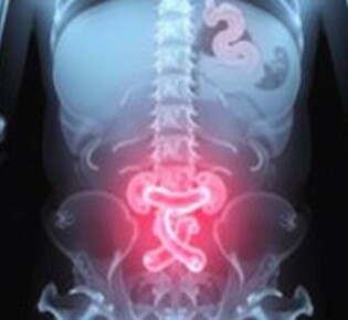 Understanding the Role of X-rays in Diagnosing Appendicitis