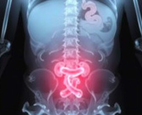 Understanding the Role of X-rays in Diagnosing Appendicitis