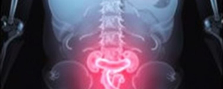 Understanding the Role of X-rays in Diagnosing Appendicitis