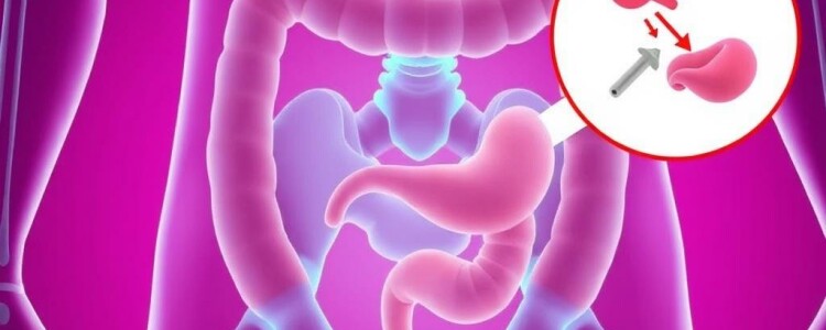 Appendicite et Constipation : Un Lien Méconnu