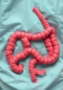 Blinddarmreste nach Operation: Probleme und Risiken verständlich erklärt