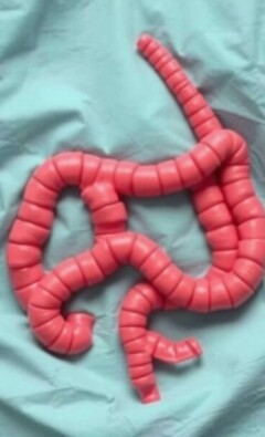 Blinddarmreste nach Operation: Probleme und Risiken verständlich erklärt