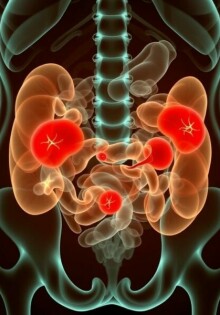 Peritonitis: inflamación generalizada del abdomen — lo que necesita saber para entender, reconocer y actuar