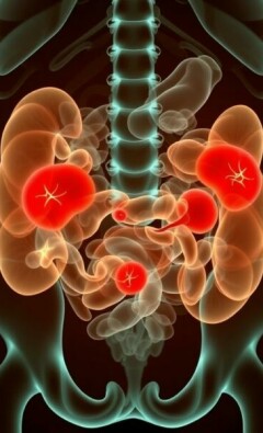 Peritonitis: inflamación generalizada del abdomen — lo que necesita saber para entender, reconocer y actuar