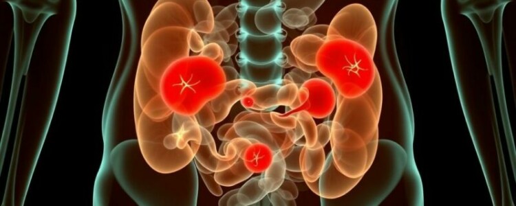 Peritonitis: inflamación generalizada del abdomen — lo que necesita saber para entender, reconocer y actuar