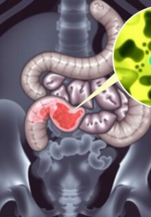 Intra-Abdominal Abscess Formation After Appendectomy: lo que todo paciente y profesional debe conocer