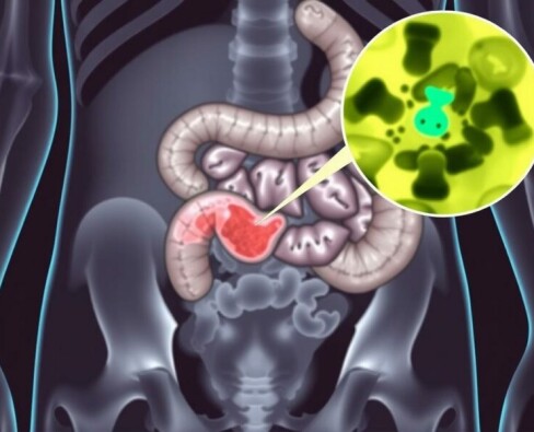 Intra-Abdominal Abscess Formation After Appendectomy: lo que todo paciente y profesional debe conocer