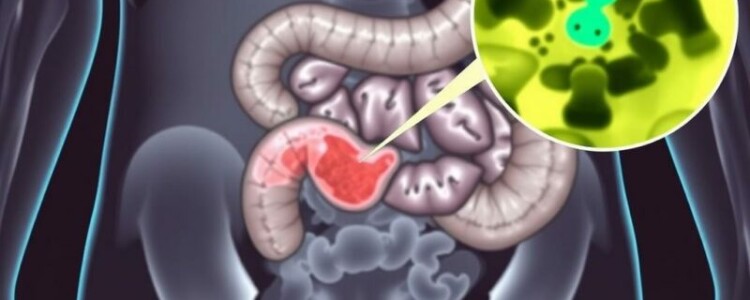 Intra-Abdominal Abscess Formation After Appendectomy: lo que todo paciente y profesional debe conocer