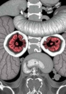 Tumores carcinoides en el apéndice: una guía clara y cercana para entenderlos