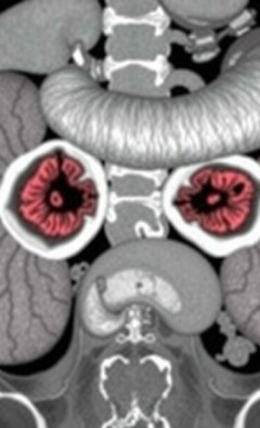 Tumores carcinoides en el apéndice: una guía clara y cercana para entenderlos
