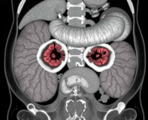 Tumores carcinoides en el apéndice: una guía clara y cercana para entenderlos