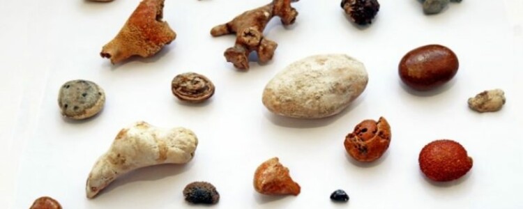 Что такое камни в почках и что заставляет их образовываться в первую очередь