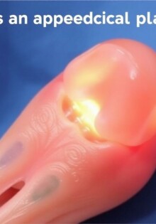 Plastrón apendicular: qué es y cómo manejarlo inicialmente sin cirugía